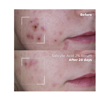 Image 5 of product Skin Republic - Salicylic Acid 2% Serum, 30 ml