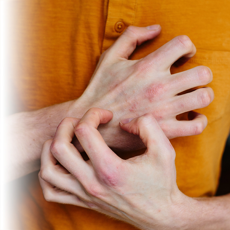 Eczéma des mains, doigts : signes, causes et traitement