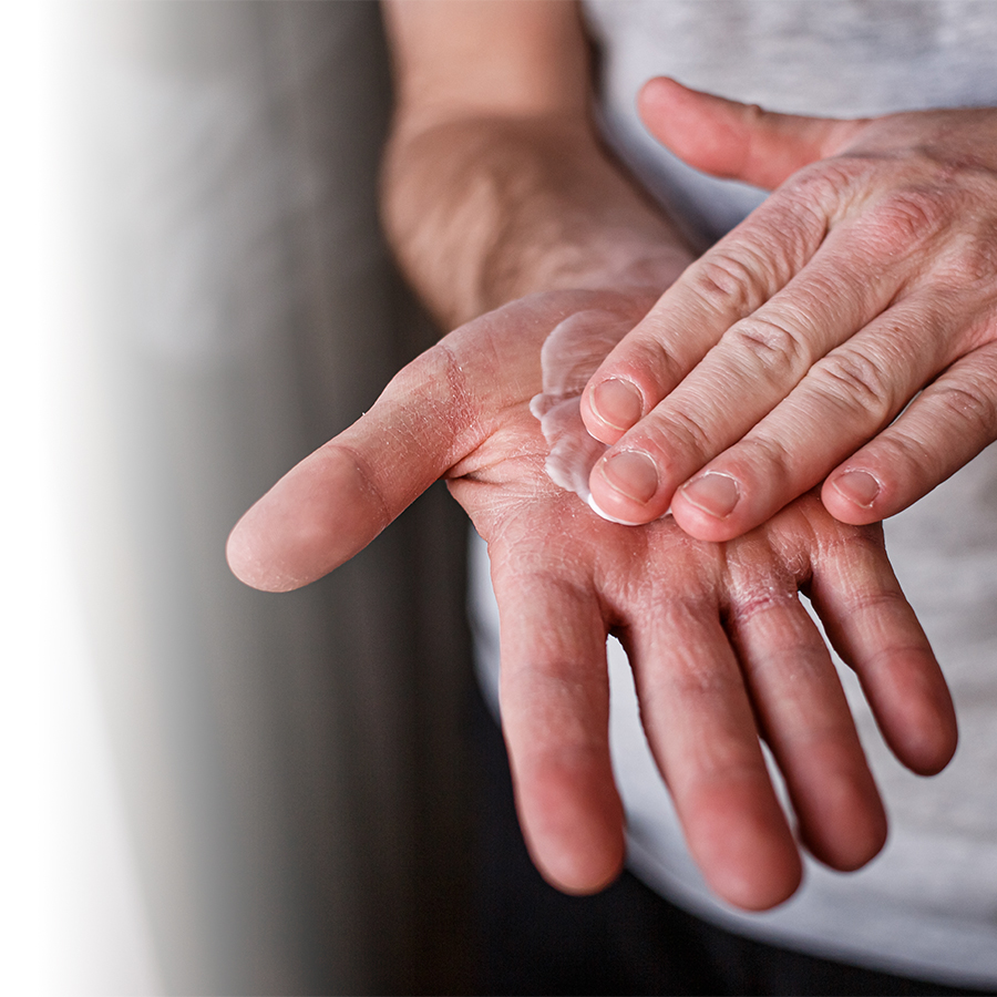Comment soigner crevasses et plaies ouvertes causées par le froid et la  déshydratation des mains 